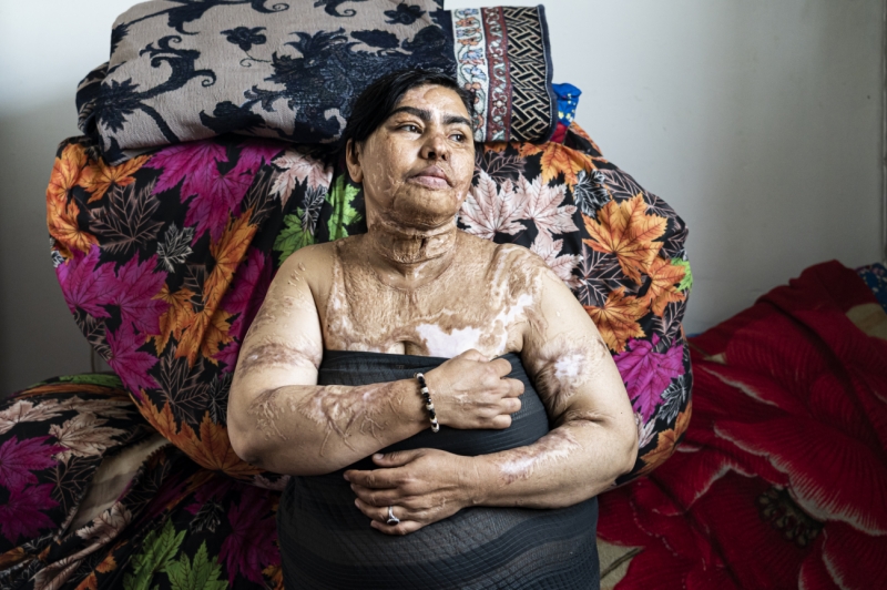 Acid attack victim